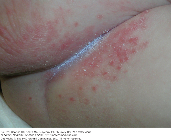 Hurricane reccomend Anus rash pictures