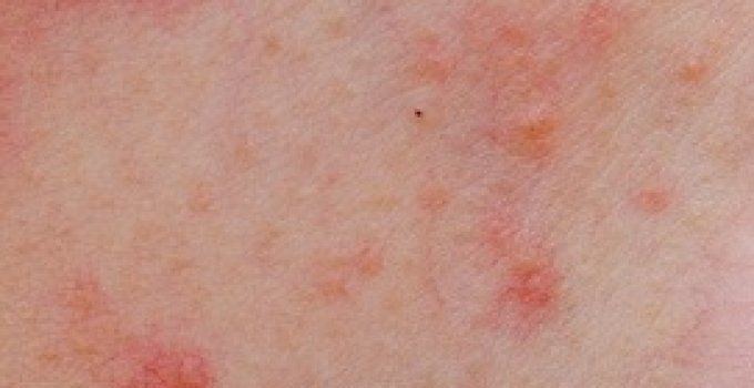 Wildberry reccomend Anus rash pictures