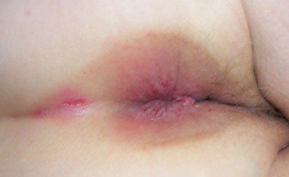 best of Pictures Anus rash