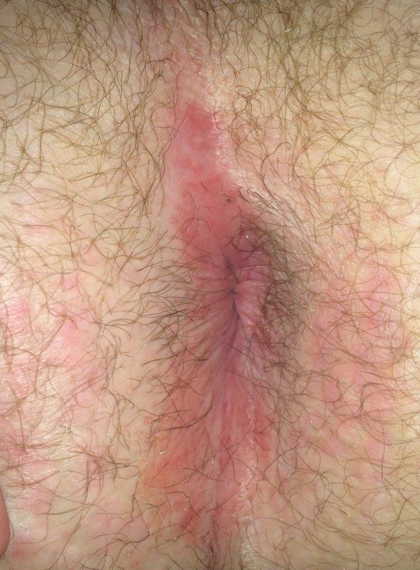 Gingersnap reccomend Anus rash pictures