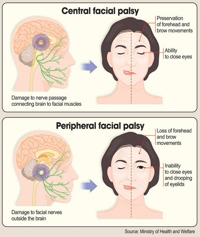 best of Facial paresis Left