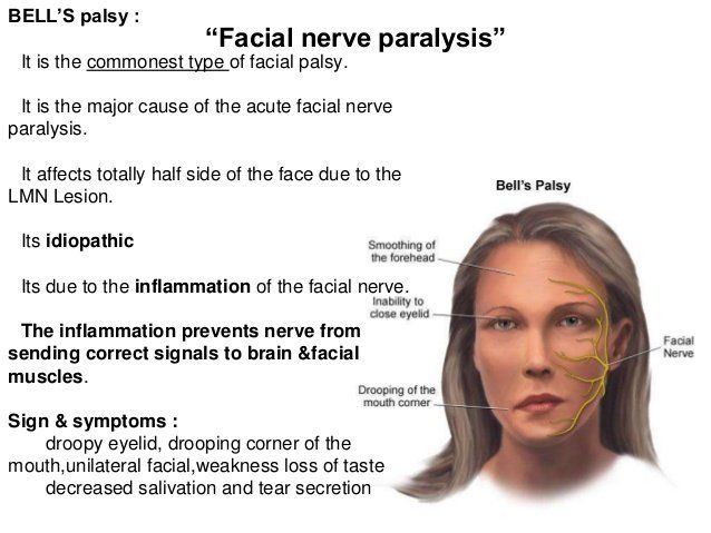 FUBAR reccomend Left facial paresis